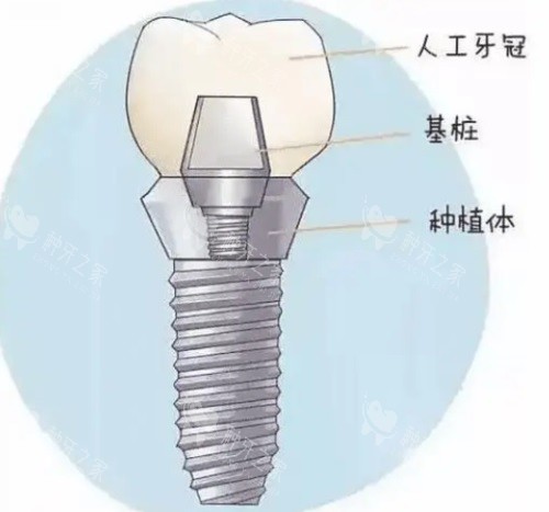 种植牙组成示意图