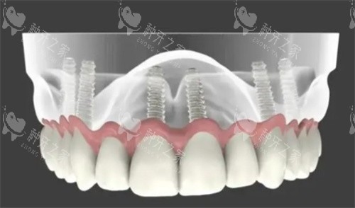 全口种植牙解析图