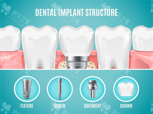 种植牙植体组成部分展示