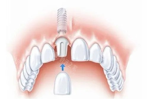 单颗种植牙安装牙冠卡通示意图