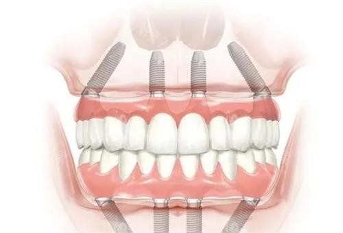 全口种植牙的示意图