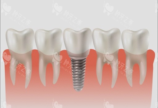 种植牙单颗漫画示意图