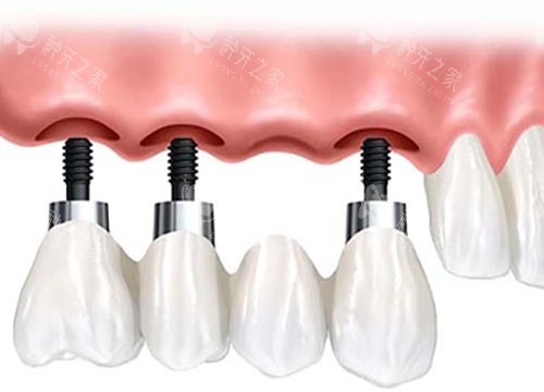 种植牙固定桥修复体