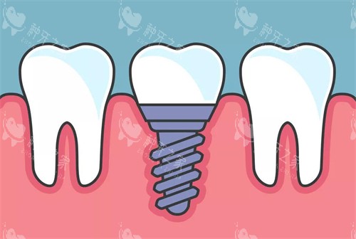 种植牙植入后漫画示意图