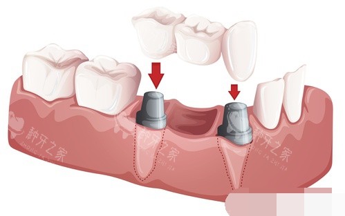 两颗种植牙安装联排牙冠漫画图
