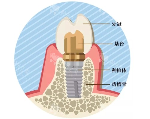 种植牙组成展示图