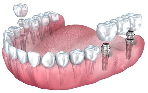 单颗烤瓷牙和连冠种植牙