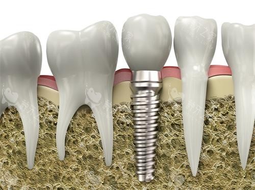 种植牙牙槽骨照片