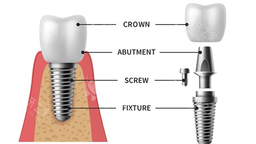 种植牙组成部分动画展示