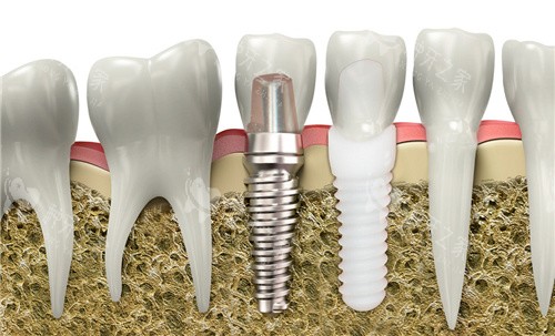 安卓健种植牙修复图