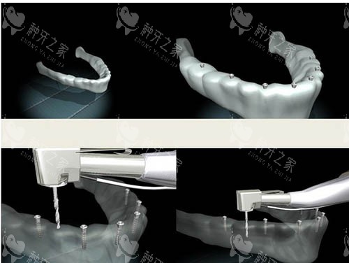 种植牙模拟步骤图