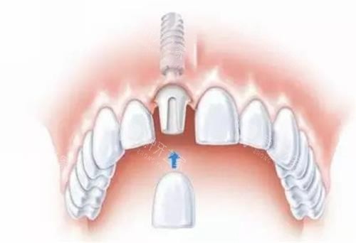种植牙的种植部位