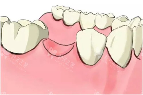 缺牙卡通示意图