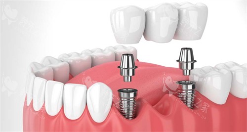 在口腔内进行种植牙