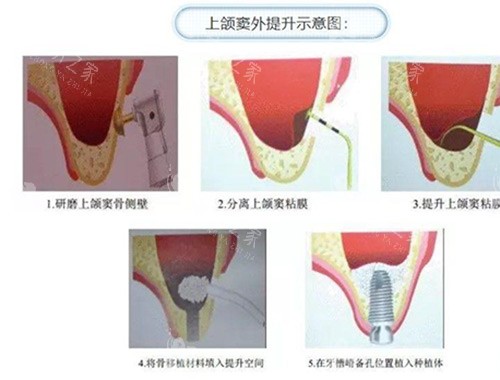 上颌窦提升过程