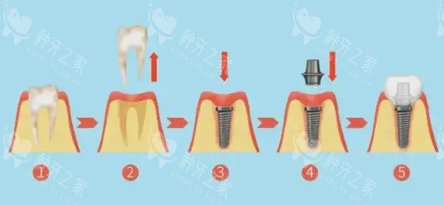 种植牙过程图片
