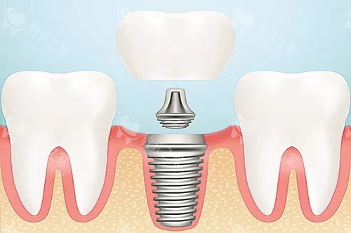 北京钛植口腔种植牙技术分析！