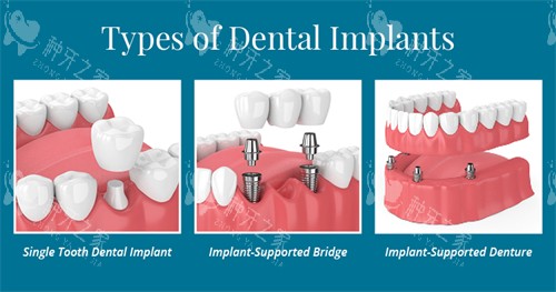 不同种植牙方式展示