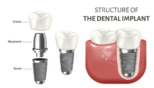 种植牙组成部分示意图