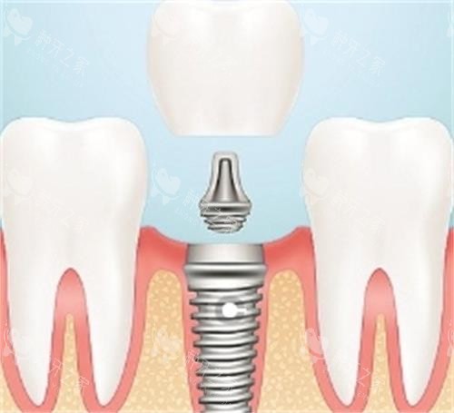 种植牙的组成部分