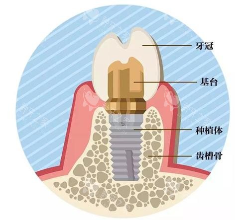 种植牙的组成