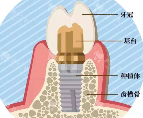 种植牙结构