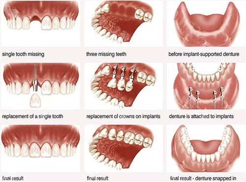 缺失牙齿进行种植牙