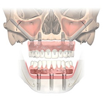 全口穿颧种植牙透视图