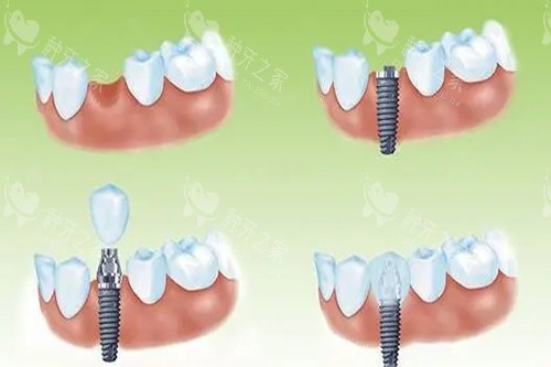单颗种植牙种植过程卡通示意图