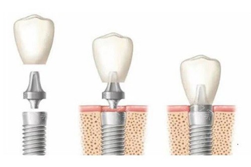 种植牙过程示意图