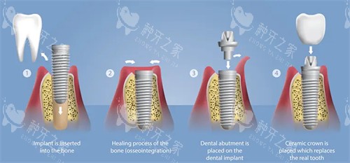 种植牙手术流程图