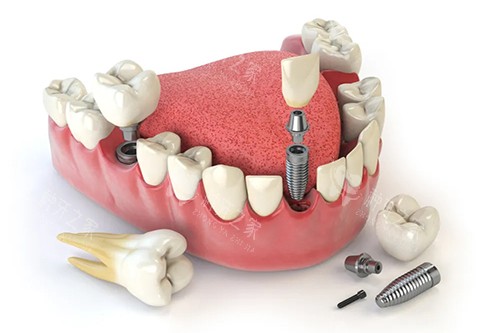 长春种植牙一颗大约多少钱？长春种植牙价格表速看