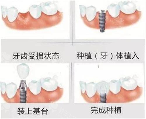种植牙的手术过程