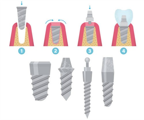 种植牙步骤和植体型号