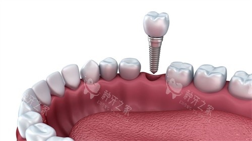 种植牙哪个品牌材料号性价比高？市面上主流种植体一览
