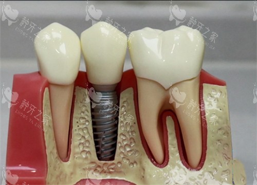 种植牙模型实物展示图