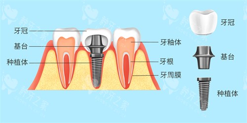 种植牙结构与牙齿结构对照漫画图