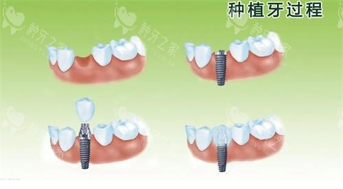 25年西安种植牙收费价目表一览：单颗仅2690元起