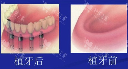 全口种植牙前后