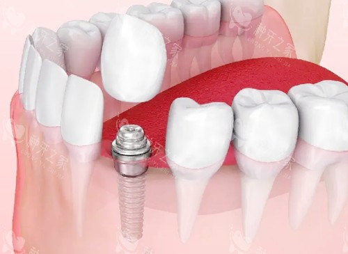 辽阳种植牙2025价格表:国产2998+，进口3k+