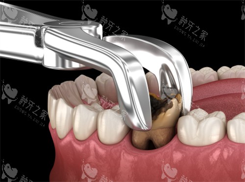 拔掉龋坏的牙齿