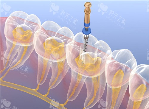 根管治疗透视图