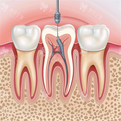 牙齿根管治疗牙髓问题漫画图
