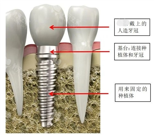 重庆巴南区嘉悦口腔种植牙价格表解答真实收费标准!