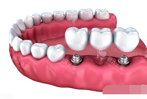 两颗种植牙安装联排牙冠漫画示意图