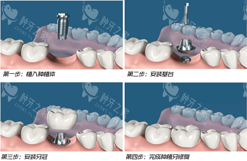 瑞安固德熊猫口腔种牙技术测评：高评分的机构可信赖