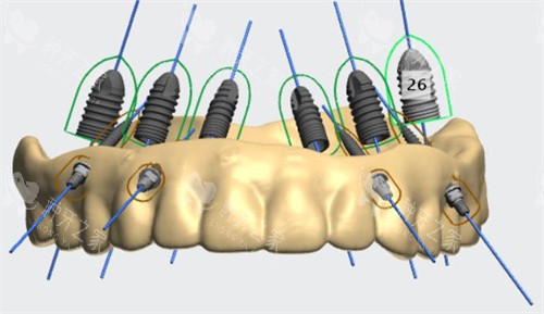 导板种植牙更精密？3大优势对比普通种植