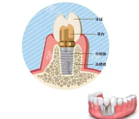 种植牙种类结构图