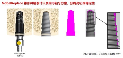 诺贝尔种植牙 (2)