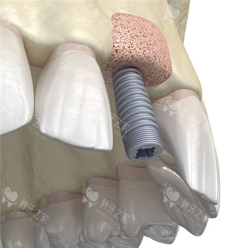 种植牙植骨